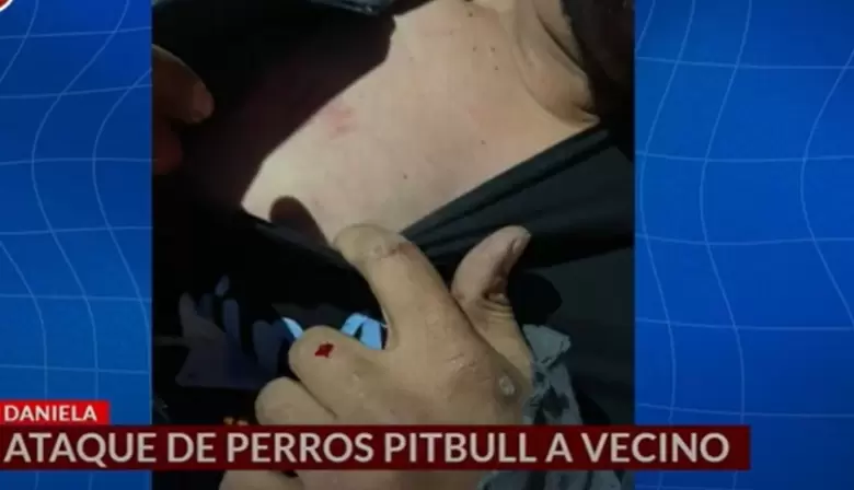 Grave ataque de dos pitbull a un vecino en el Barrio Parque: terminó con la mano reconstruida